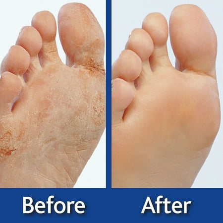 Genie Feet Exfoliating Foot Peel Cream 4 oz